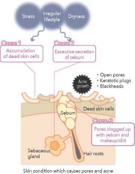 Skin condition which causes pores and acne